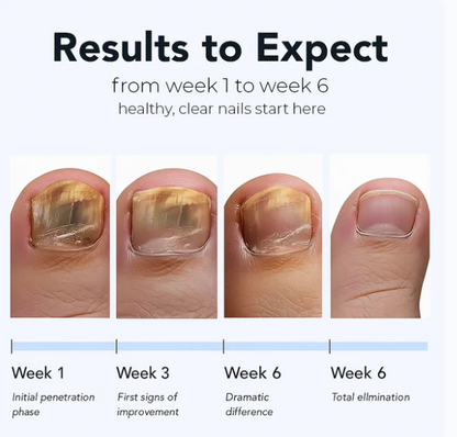 Nail fungus Removal Patches - Noyré